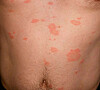 pityriasis rosea gravid pityriasis rosea gravid